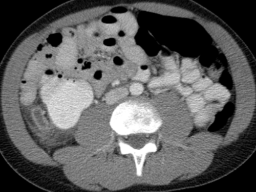 CT1